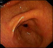 Gastroskopie