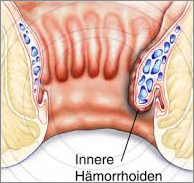 Haemorrhoiden